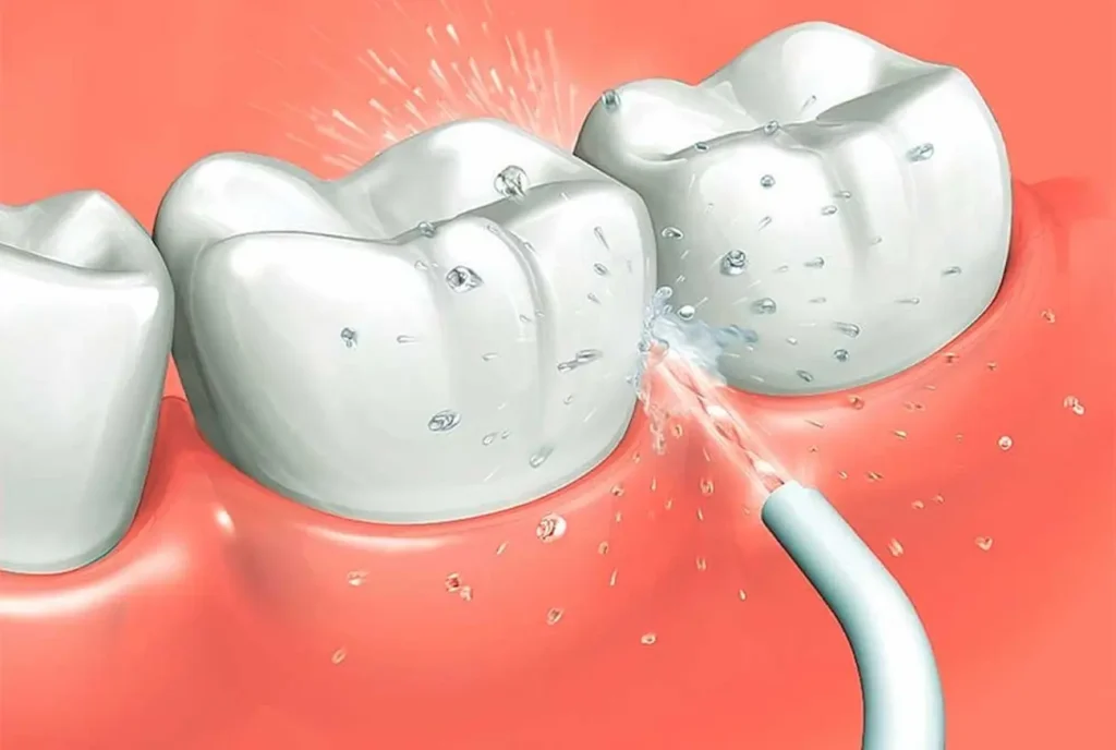 This is how to use dental irrigator