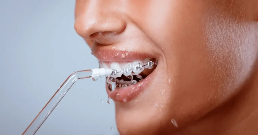 Why should you use a dental irrigator to clean your braces?