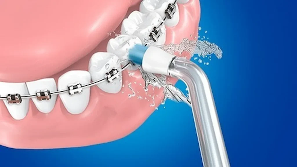 We explain how to use a dental irrigator for brackets