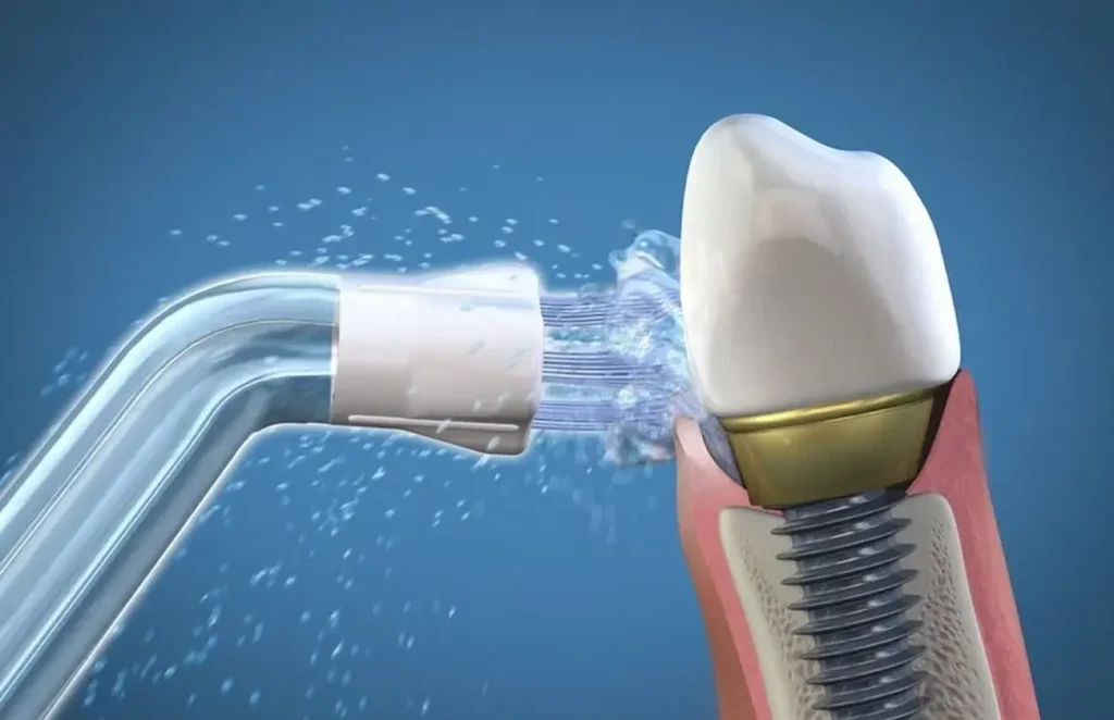Implantes irrigador dental