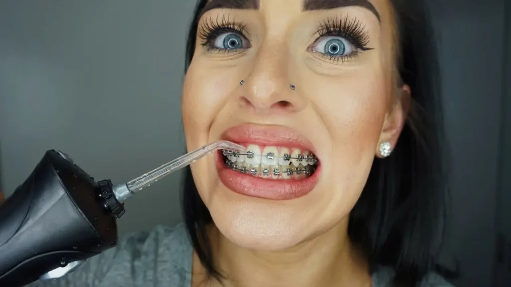 ¿Es bueno usar el irrigador dental con brackets?